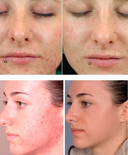 ABR peeling leírás, ár és értékelés (Szentföld ADB peeling) ABR peeling leírás árak és vélemények