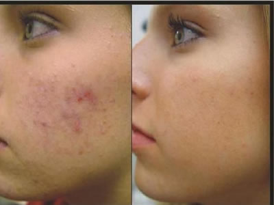 Abr Peeling Recenzii