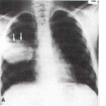 Abscess, ce este această fotografie, tratament, simptome?