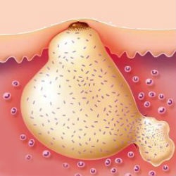 Abcesul - diagnosticul de abces, manifestări, tratamentul abcesului - abstinență dystonie, dezvoltare, likuvannya