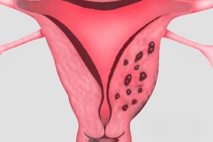 Adenomyosis tünetek és kezelések, okai és diagnózis