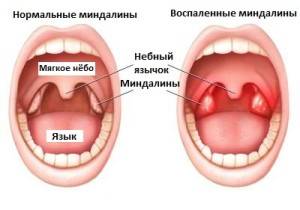 Angina este contagioasă în stadiul acut, care curge cu formarea unui abces