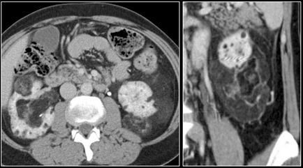 vese angiomyolipoma