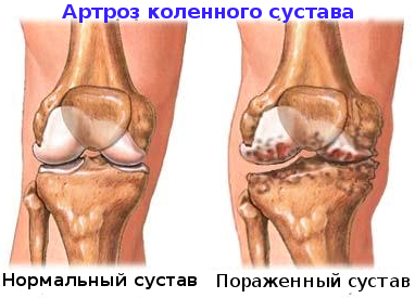 Артроз колінного суглоба (гонартроз)