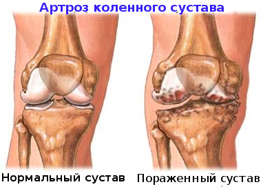 Gonarthrosis (gonartrózis) (közös) Osteoarthritis a térd (gonartrózis)