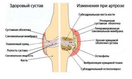 Osteoarthritis a váll ízületi tünetek, okok, kezelés