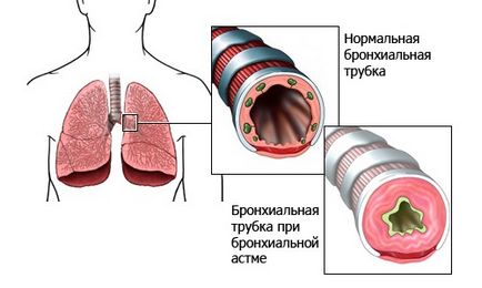 Astm bronsic, simptome și metode de tratament folcloric