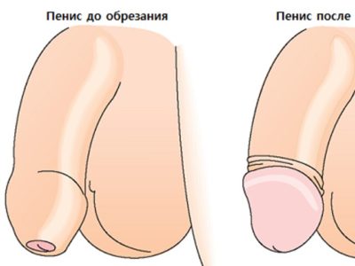 Баланопостит у дитини (гострий, гнійний) лікування запалення крайньої плоті