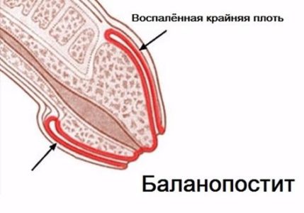 Balanopotită la copil (tratamentul acut, purulent) al inflamației preputului