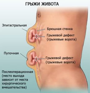Bandaj pentru tipurile de hernie abdominală și reguli de aplicare a acesteia de la hernia abdominală