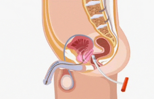 Puterea terapeutică a dietei cu prostatită și adenom de prostată