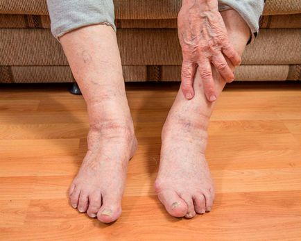 Frecvente crampe picior la persoanele în vârstă primul ajutor sau cum să calmeze durerea