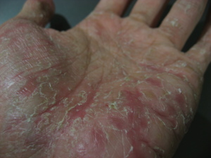 Ce cauzeaza o exacerbare a eczemelor, un site sanatos al pielii