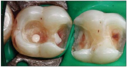 Revizia dentară, articole, terapeutice, clasificarea tehnicilor de restaurare