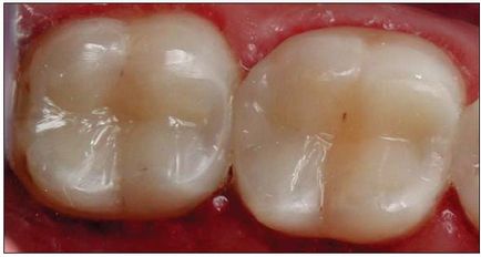 Revizia dentară, articole, terapeutice, clasificarea tehnicilor de restaurare