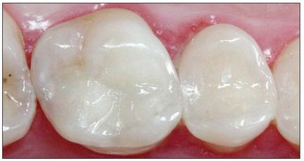 Dental-revue, статті, терапевтична, класифікація відновлювальних методик