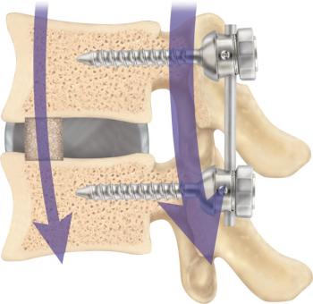 Diagnosticul și tratamentul deplasărilor discului și vertebrelor