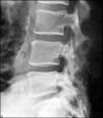 Diagnosticul și tratamentul deplasărilor discului și vertebrelor