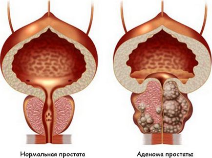 Dieta cu adenom de prostată pe care o puteți și ce nu puteți mânca cu hiperplazie prostatică