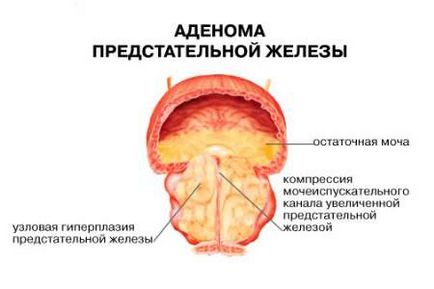 Дієта при аденомі простати що можна і не можна їсти при захворюванні передміхурової залози