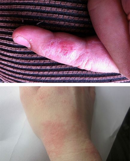 Eczematoasa cauze dermatita, imagine clinica, tratament