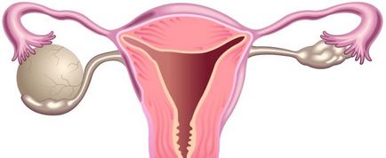 Chistul endometrioid cauzează, simptome și tratament