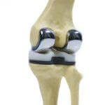 Ендопротезування колінного суглоба - хід операції і види протезів