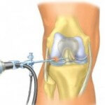 Endoproteticele articulației genunchiului - procedura și tipurile de proteze
