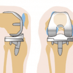 Ендопротезування колінного суглоба - хід операції і види протезів