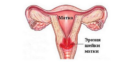 Eroziunea colului uterin după naștere, fiica crește, fiul crește