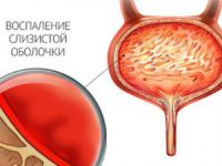 Фуросемід при циститі дію препарату, його особливості та протипоказання