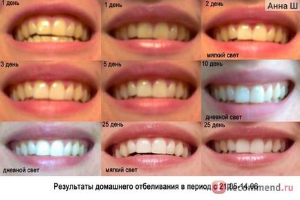 Гель для відбілювання зубів discus dental usa nite white acp - «мій особистий вибір для домашнього