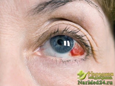 Hemophthalmus szemét -, hogy miért van, és hogyan kell kezelni azt