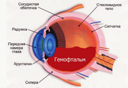 Hemophthalmus cauzează cauze, simptome și tratamentul bolii