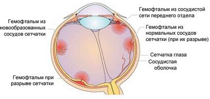 Hemophthalmus cauzează cauze, simptome și tratamentul bolii