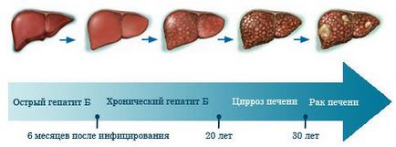 Hepatita, tratamentul hepatitei