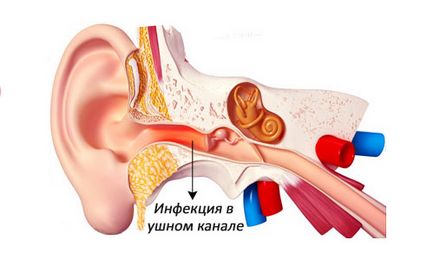 Geranium, tinctură de calendula, aloe din durerea urechii la otită