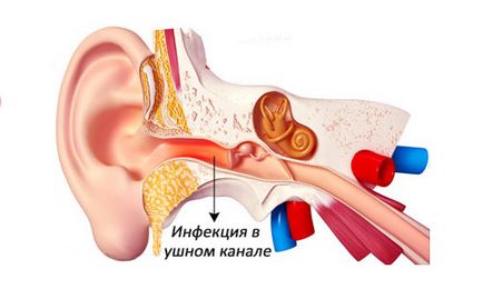 Герань, настоянка календули, алое від болю у вусі при отиті