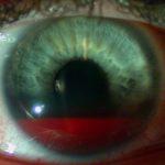 Очні краплі від глаукоми і очного тиску список і назви