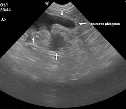 Procedeele supurative ale țesutului retroperitoneal