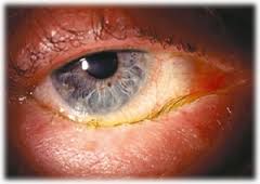 Гонорея очей симптоми захворювання