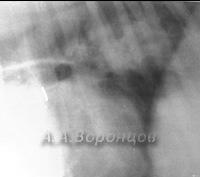 Trupurile străine ale esofagului toracic la câini