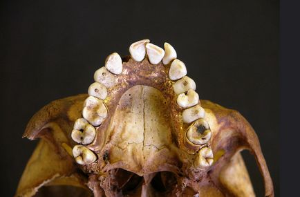 Istoria protezelor - de la metode antice la moderne de proteze, denta stomatologie