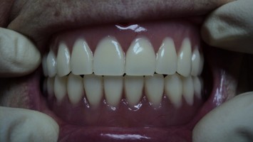 Історія протезування - від найдавніших до сучасних способів протезування, стоматологія denta