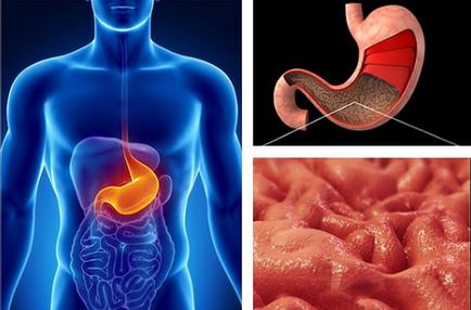 Киселини в стомаха да се отървем от киселини в стомаха народни средства
