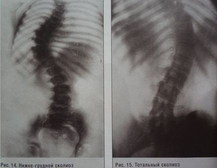 Cum să fixați o coloană vertebrală