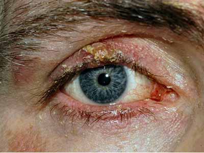 Як лікувати демодекс очей за допомогою народної медицини