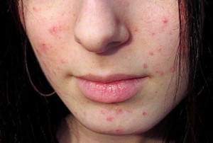 Hogyan állapítható meg, hogy a kiütések és bőrvörösség az arcon, az allergiás jellegű hogyan lehet azonosítani és