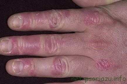 Mi psoriasis fotó betegségek különböző testrészek