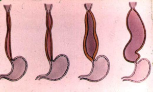 Simptome cardiovasmice esofagiene, cauze, diagnostic